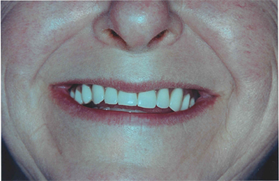Salisbury Dentures