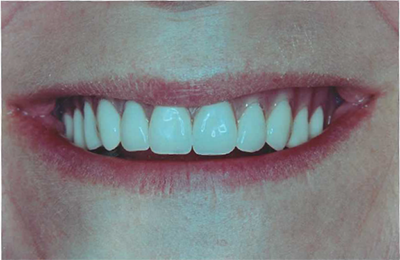Dentures in Salisbury